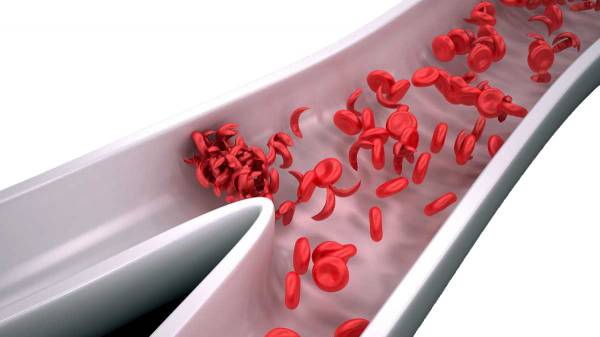 Herbs Show Promise in Managing Sickle Cell Anemia